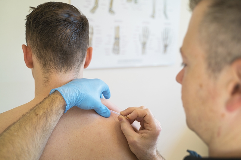 Meneer zonder shirt krijgt een dry needling behandeling in zijn rug van een fysiotherapeut